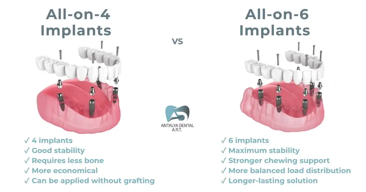All-on-4 vs. All-on-6 Implants in Antalya: Which one is right for you?