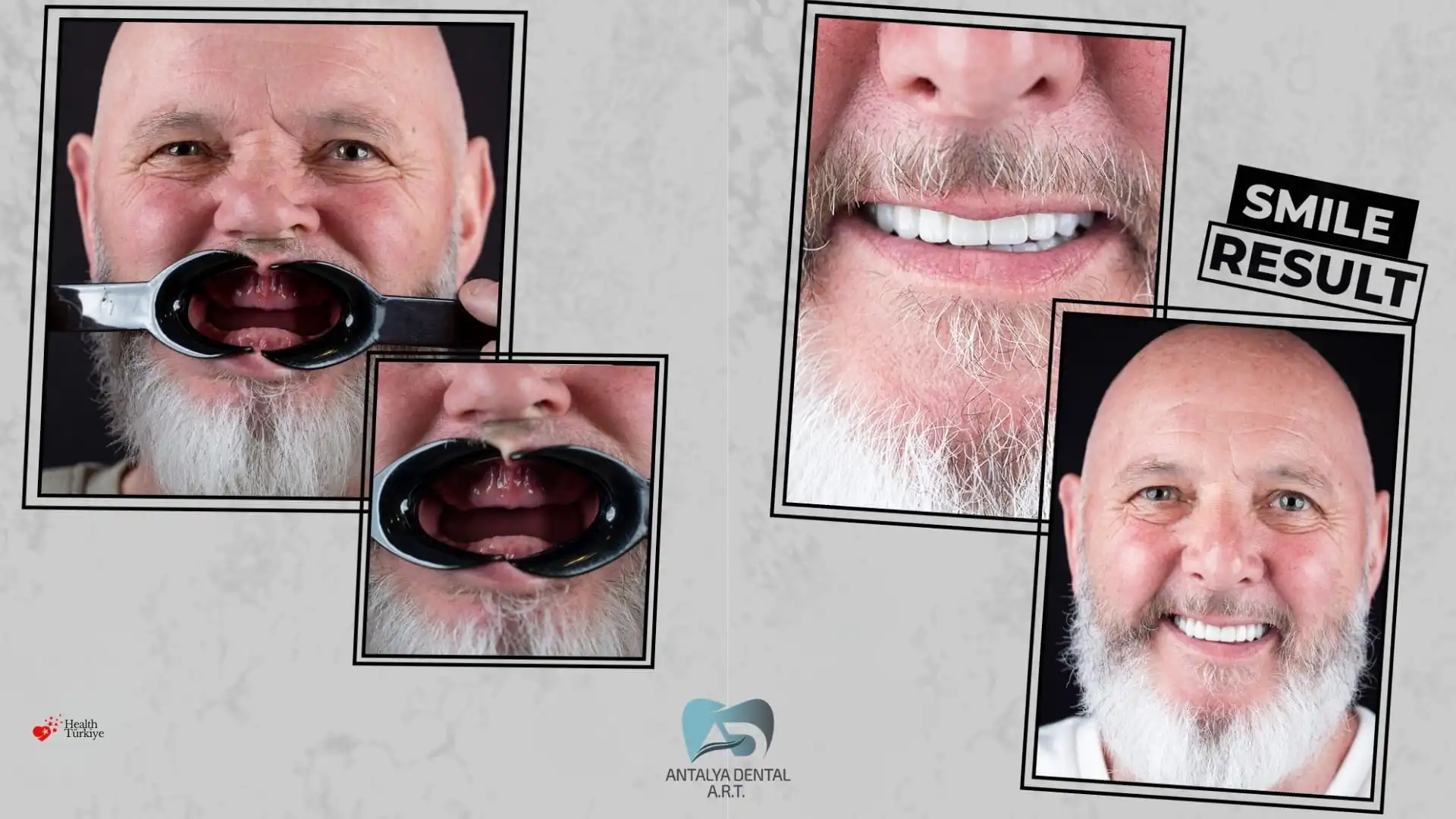 All-on-4 vs All-on-6 Implants in Antalya, Turkey