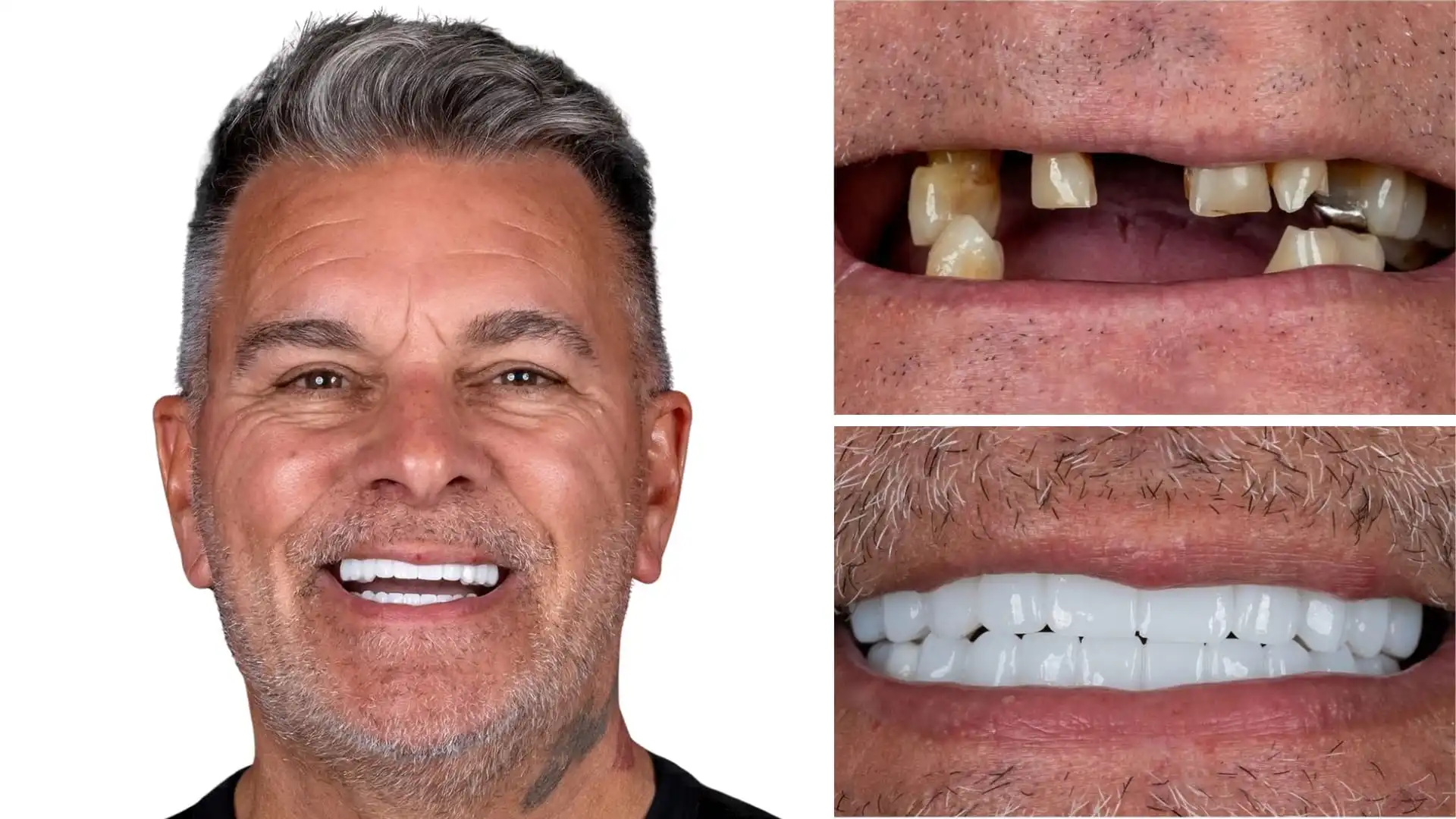 All-on-6 dental implants in Antalya, Turkey All-on-6 dental implants in Antalya, Turkey