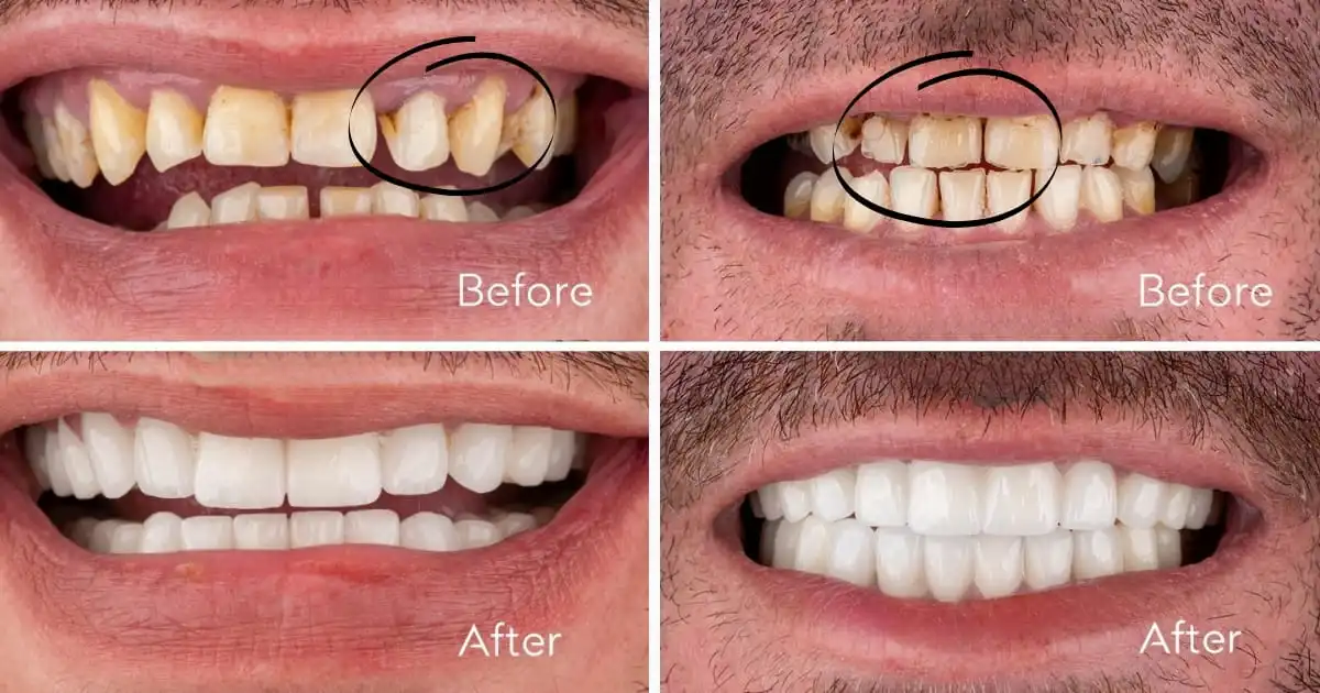 How are black lines on teeth treated in Antalya, Turkey