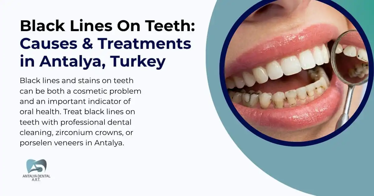 Black Lines On Teeth: Causes & Treatments in Antalya, Turkey