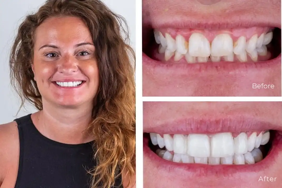 Composite Bonding in Turkey