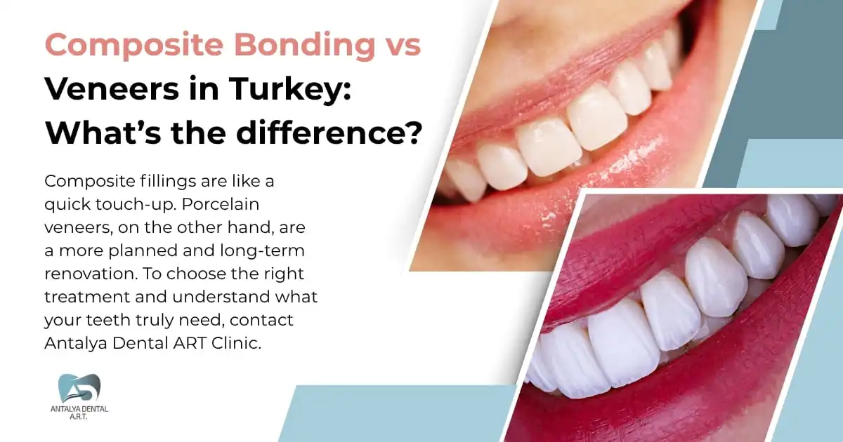 Composite Bonding vs Veneers in Turkey: What’s the difference?