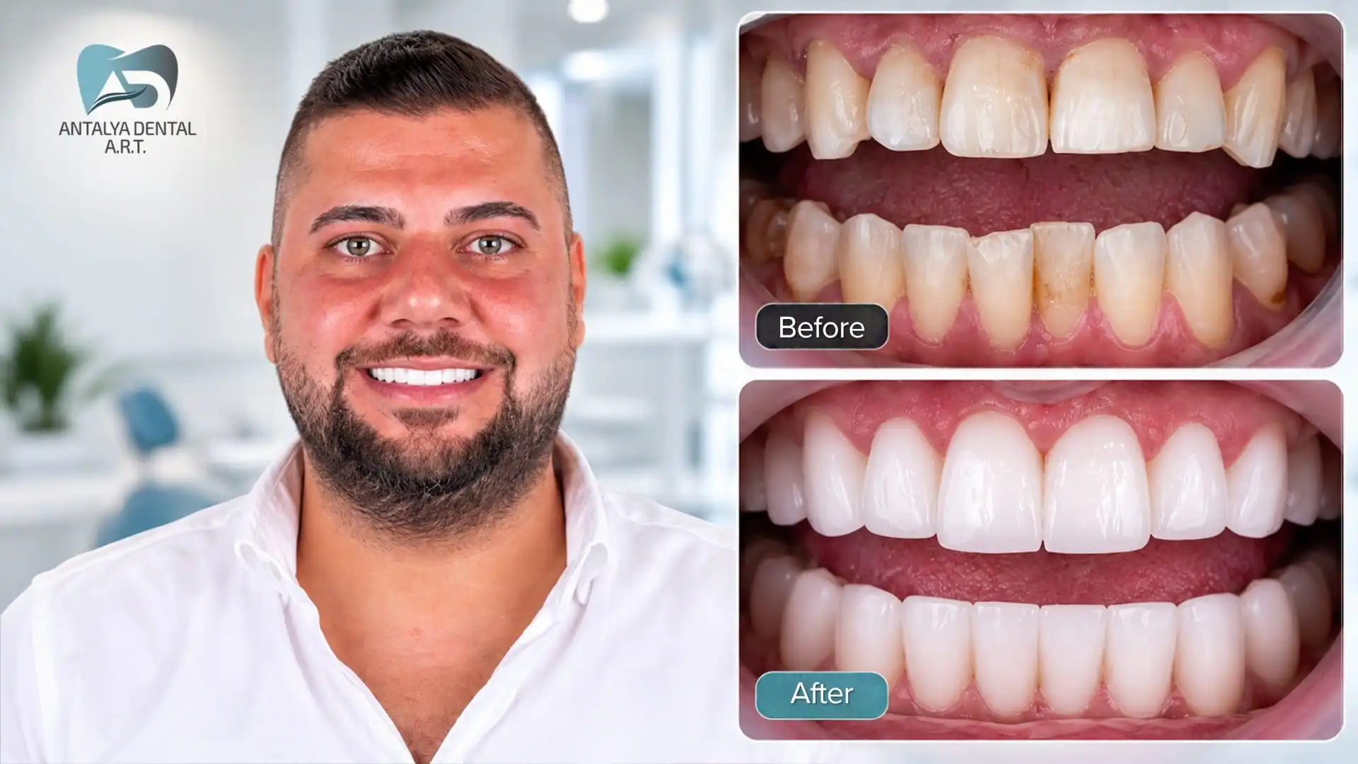 Composite Veneers Vs Porcelain Veneers in Antalya, Turkey