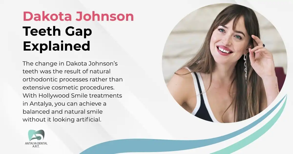 Dakota Johnson Teeth Gap Explained | Antalya Dental ART Clinic