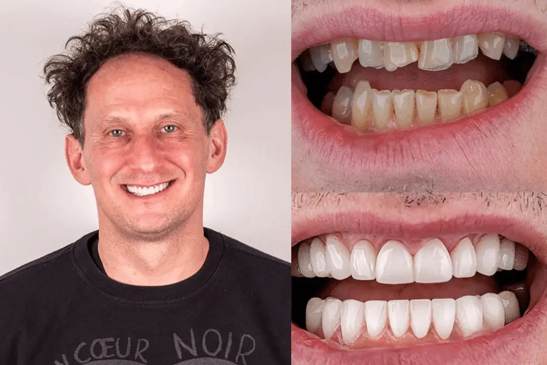 Dental Implant Aftercare