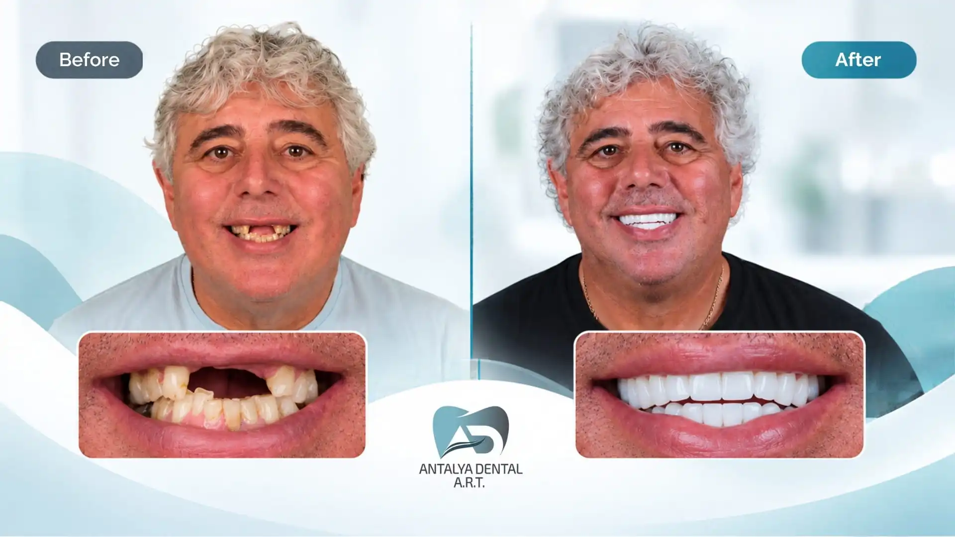 Dental implants before and after in Antalya, Turkey - 1