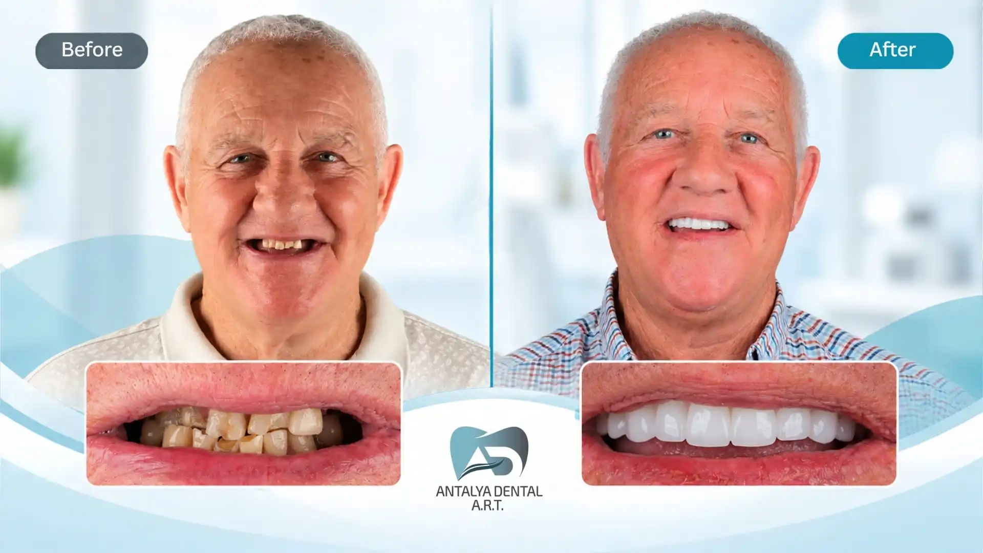 Dental implants before and after in Antalya, Turkey - 2