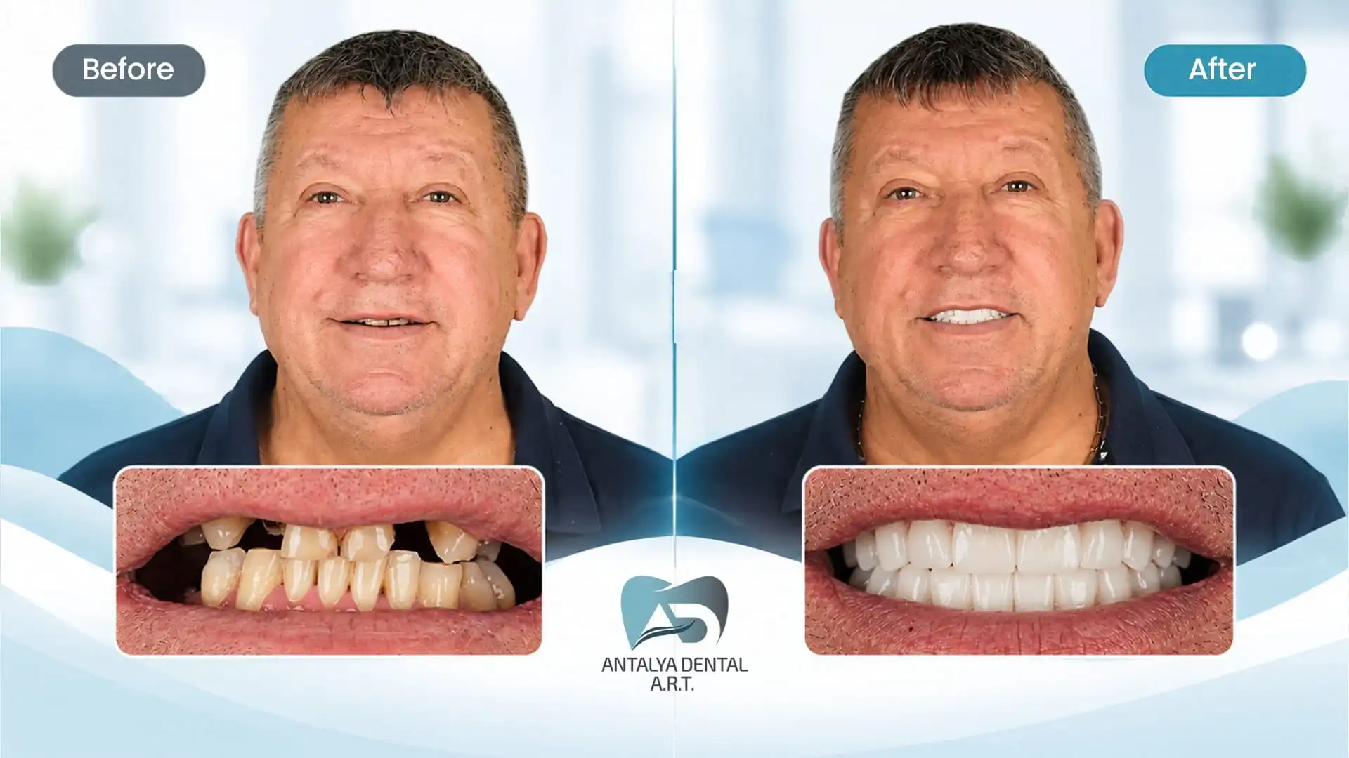 Dental implants before and after in Antalya, Turkey - 3
