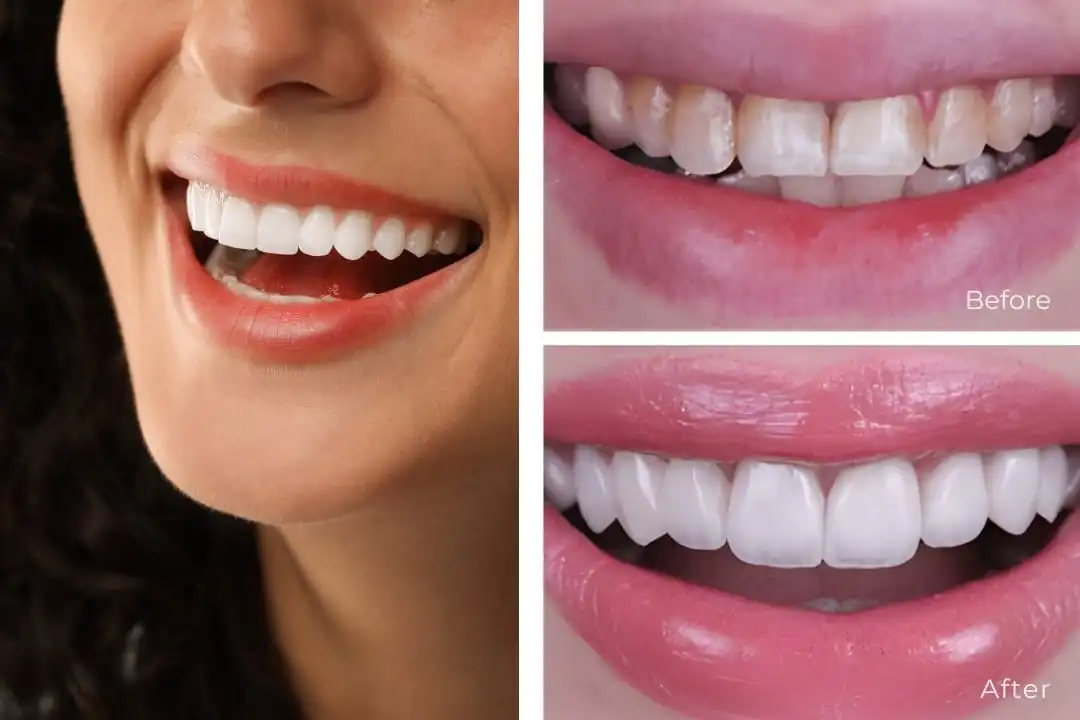 Dental Veneers in Turkey
