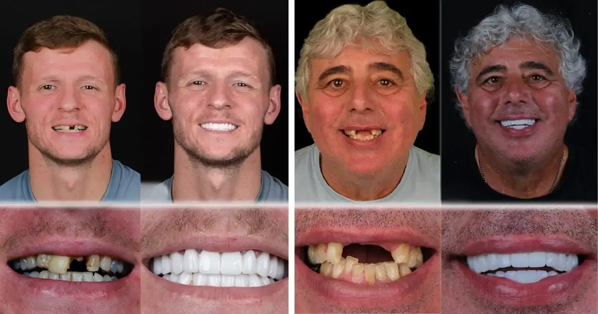 Front tooth implants Antalya, Turkey
