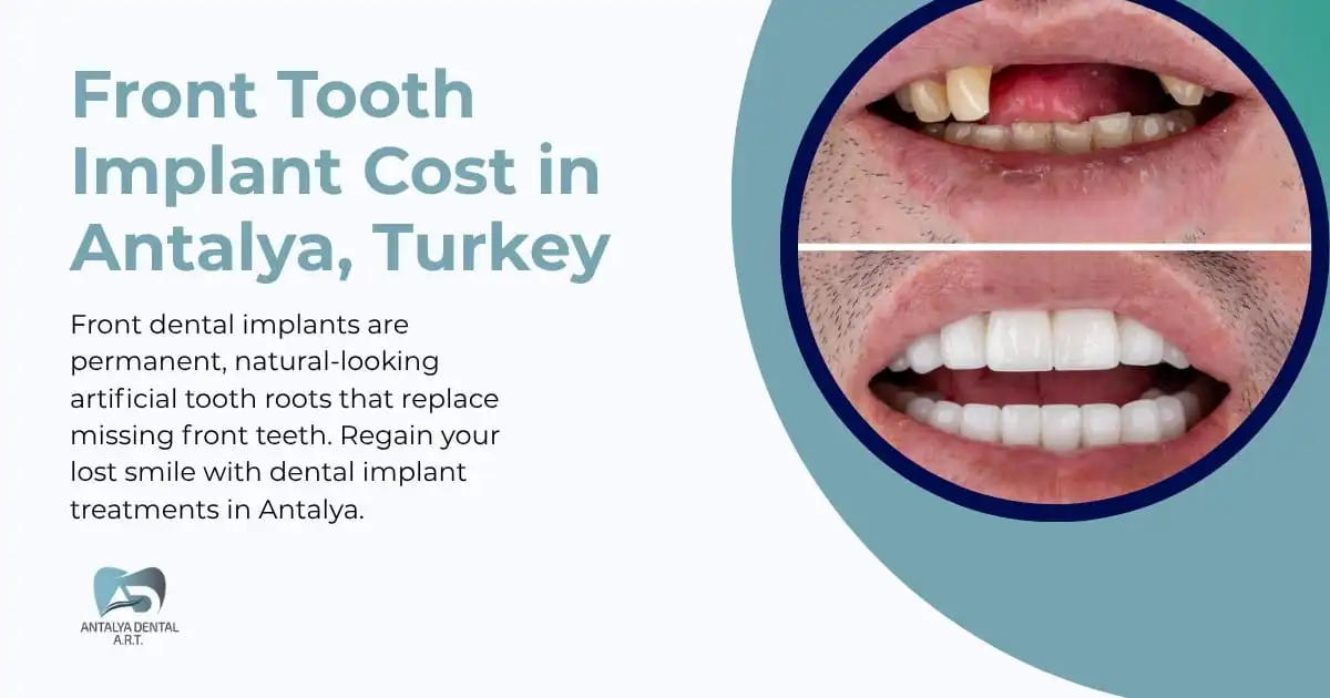 Front Tooth Implants in Antalya, Turkey 