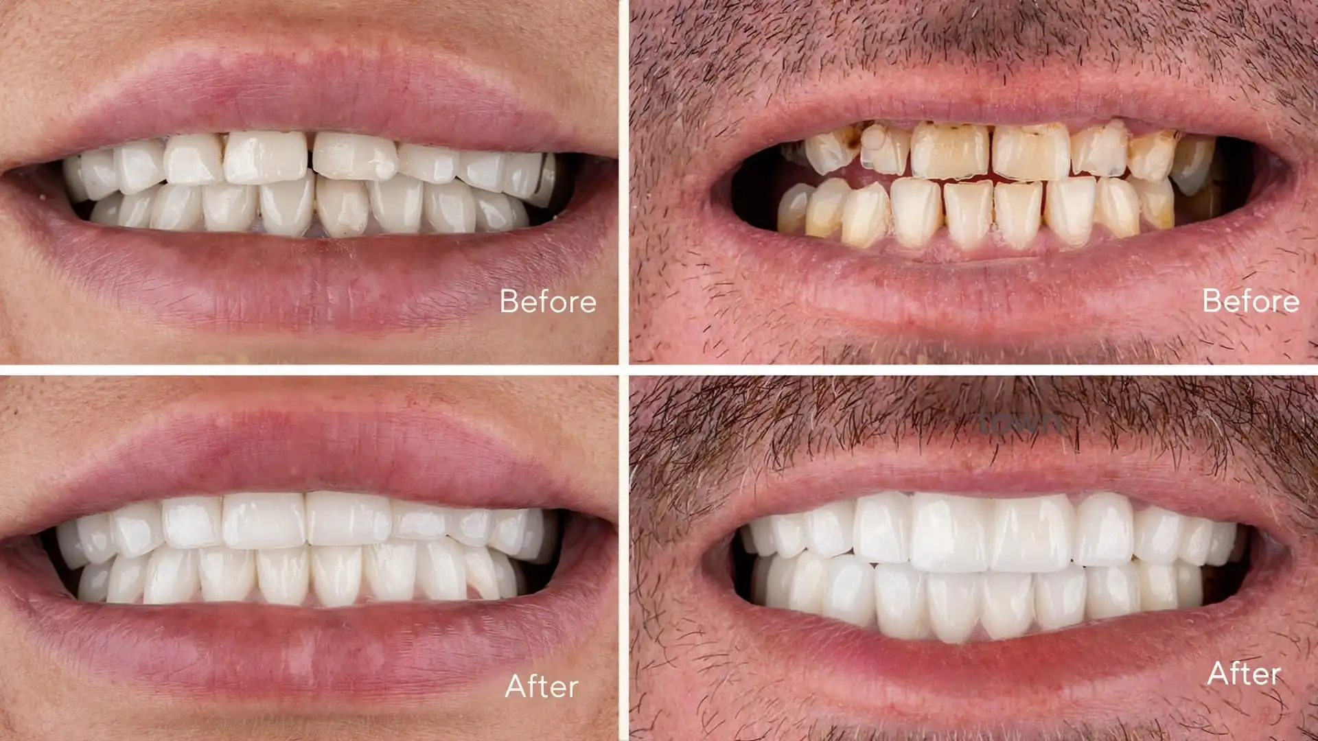 How to choose the right shade for veneers and crowns?