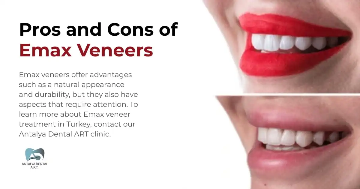 Pros and Cons of Emax Veneers