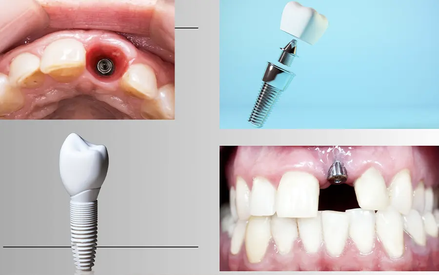 What materials are dental implants made of?